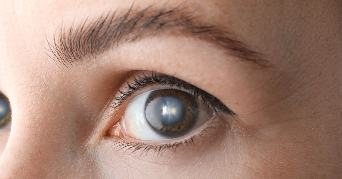 Tratamiento de bioestimulación celular para las cataratas