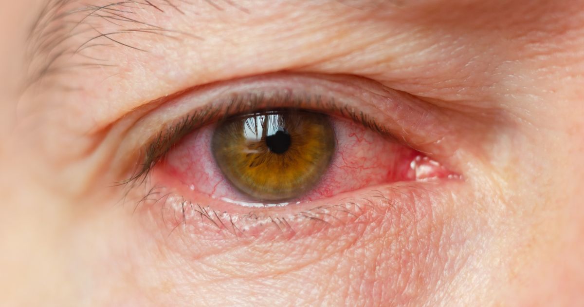 Tratamiento de bioestimulación celular para la conjuntivitis